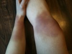 Andrea James Lui's left arm and right leg after fight rehearsals with Trish Stratus for Bail Enforcers